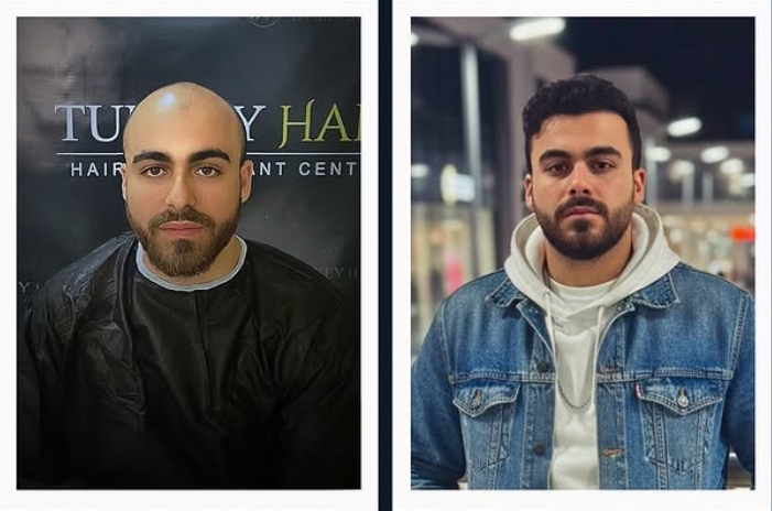 Saç ekimi öncesi sonrası 1 - MicroFUE 3500 greft