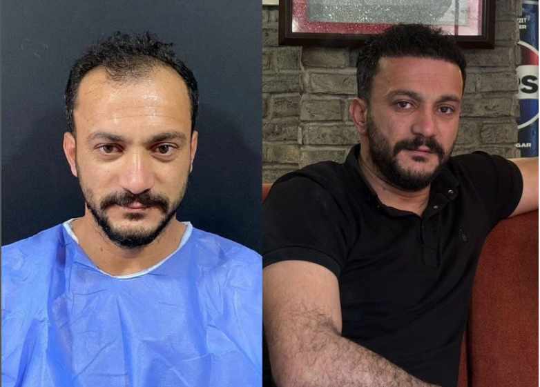 Saç ekimi öncesi sonrası 10 - MicroFUE 3800 greft