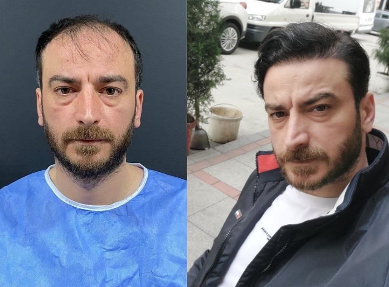 Saç ekimi öncesi sonrası 13 - MicroFUE 3600 greft