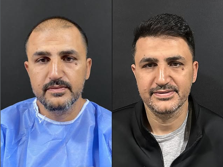 Saç ekimi öncesi sonrası 14 - MicroFUE 3400 greft