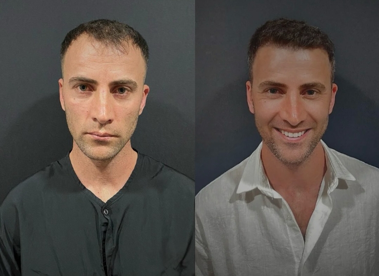 Saç ekimi öncesi sonrası 15 - MicroFUE 3800 greft