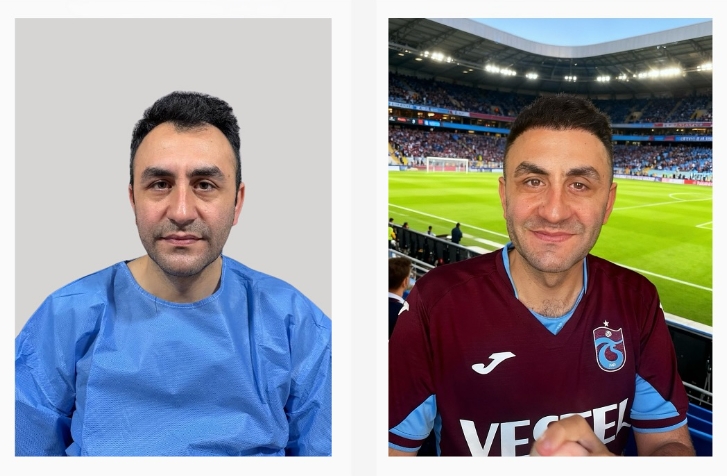 Saç ekimi öncesi sonrası 3 - MicroFUE 4000 greft