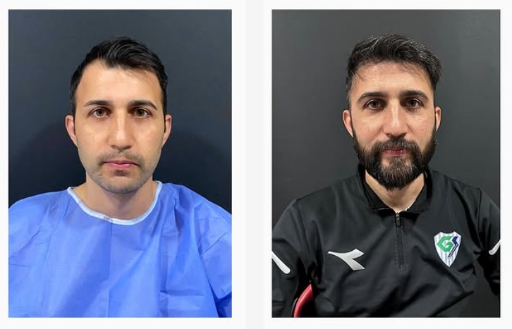 Saç ekimi öncesi sonrası 4 - MicroFUE 2500 greft