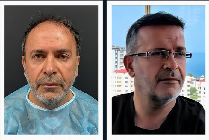 Saç ekimi öncesi sonrası 5 - MicroFUE 3200 greft